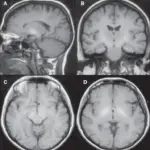 Metabolic Diseases of the Central Nervous System