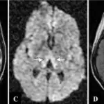 Metabolic and Nutritional Neuropathies