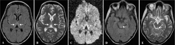 Metabolic and Nutritional Neuropathies