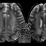 Metachromatic Leukodystrophy