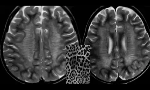 Metachromatic Leukodystrophy