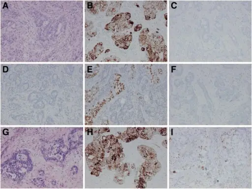 Metastasis to the Liver