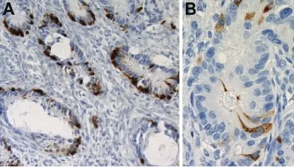 Metastatic Tumors to the Ovaries