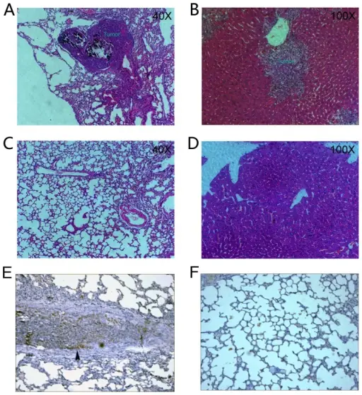 Metastatic Tumors