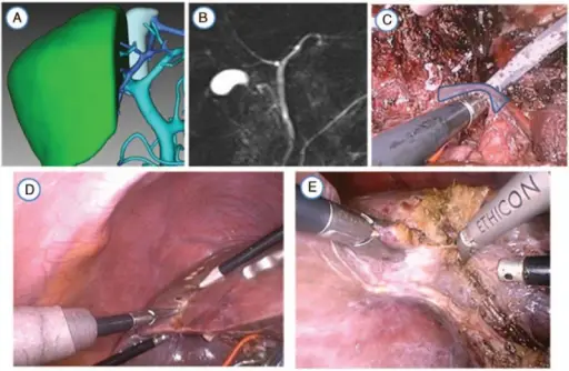 Method to Increase Organ Transplant Life