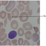 Microangiopathic Hemolytic Anemia