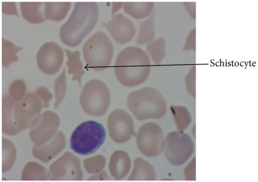 Microangiopathic Hemolytic Anemia