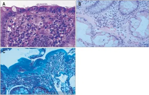 Microscopic Colitis