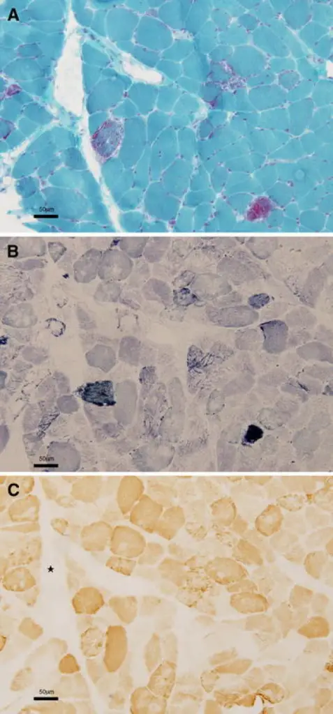 Mitochondrial Encephalomyopathies