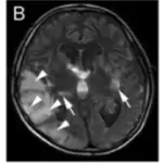 Mitochondrial Encephalomyopathy Lactic Acidosis and Stroke-like Episodes (MELAS)