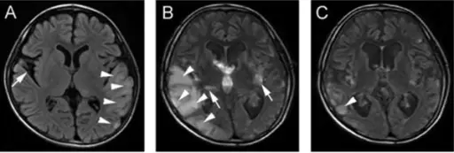 Mitochondrial Encephalomyopathy Lactic Acidosis and Stroke-like Episodes (MELAS)