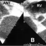 Mitral Valve Prolapse