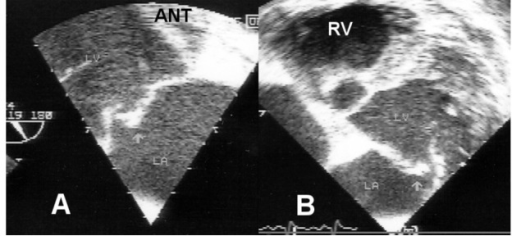 Mitral Valve Prolapse