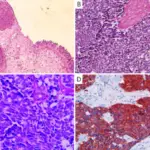 Mixed Carcinoma of the Bladder