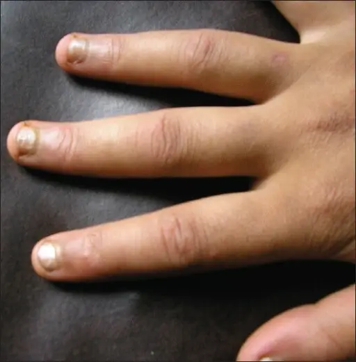 Mixed Connective Tissue Disease