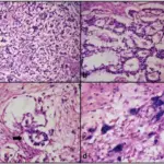 Mixed Germ Cell Tumors of the Ovary