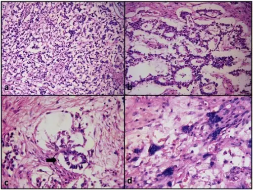 Mixed Germ Cell Tumors of the Ovary