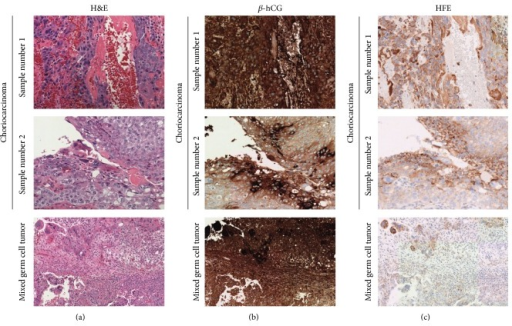 Mixed Germ Cell Tumors