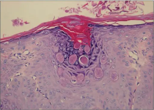 Molluscum Contagiosum