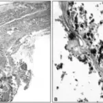 Monckeberg Medial Sclerosis