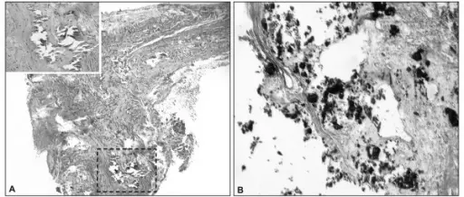 Monckeberg Medial Sclerosis