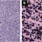 Mononucleosis