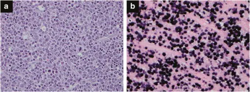 Mononucleosis