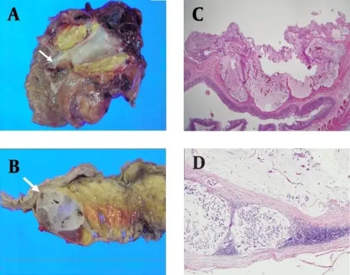 Mucinous Carcinomas