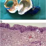 Mucinous Cystic Neoplasms