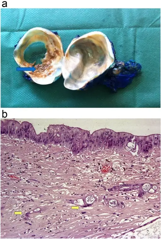 Mucinous Cystic Neoplasms