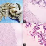 Mucinous Tumors of the Ovary