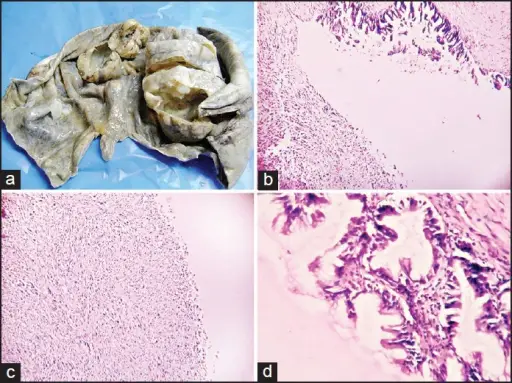 Mucinous Tumors of the Ovary