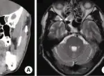 Mucocele