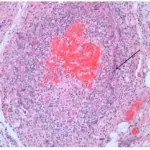 Mucormycosis