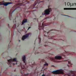 Mucormycosis Fungal Infection