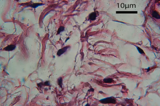 Mucormycosis Fungal Infection