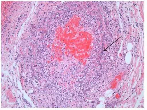 Mucormycosis