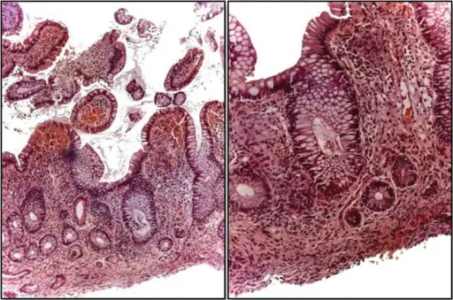 Mucosal Atrophy