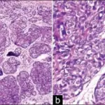 Muir-Torre Syndrome