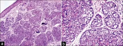 Muir-Torre Syndrome