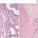 Multicystic Renal Dysplasia