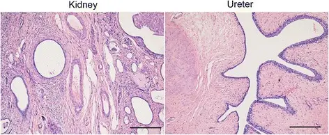 Multicystic Renal Dysplasia