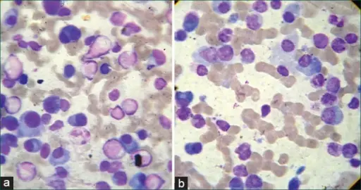 Multiple Myeloma