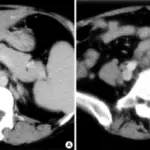 Multiple Organ Dysfunction