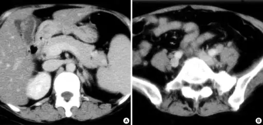 Multiple Organ Dysfunction