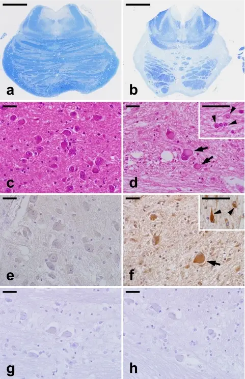 Multiple System Atrophy