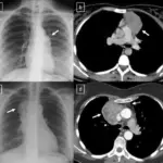 Myasthenia Gravis