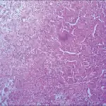 Mycobacterial Arthritis