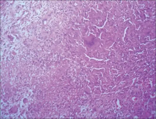 Mycobacterial Arthritis