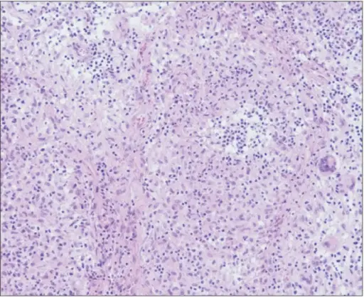 Mycobacterial Osteomyelitis